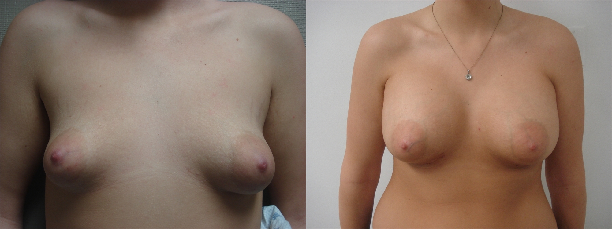 Breast Augmentation Before and After Seattle and Tacoma, WA