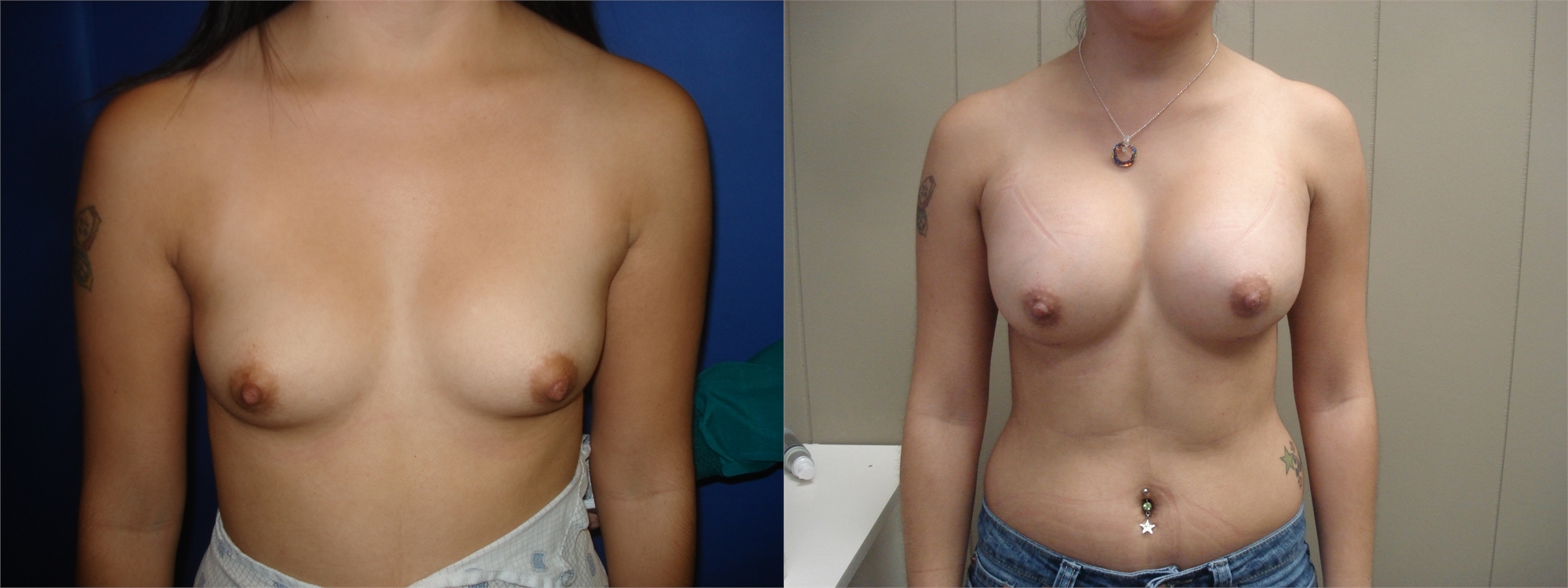 Before Breast Augmentation Surgery Photo Seattle and Tacoma, WA