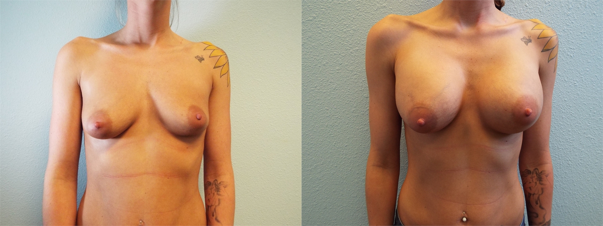 Before and After Breast Augmentation Surgery Tacoma, WA