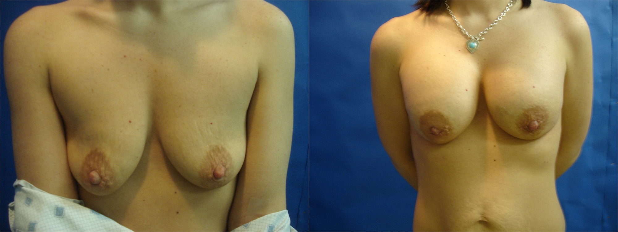 Before and After Photos Breast Augmentation Tacoma, WA