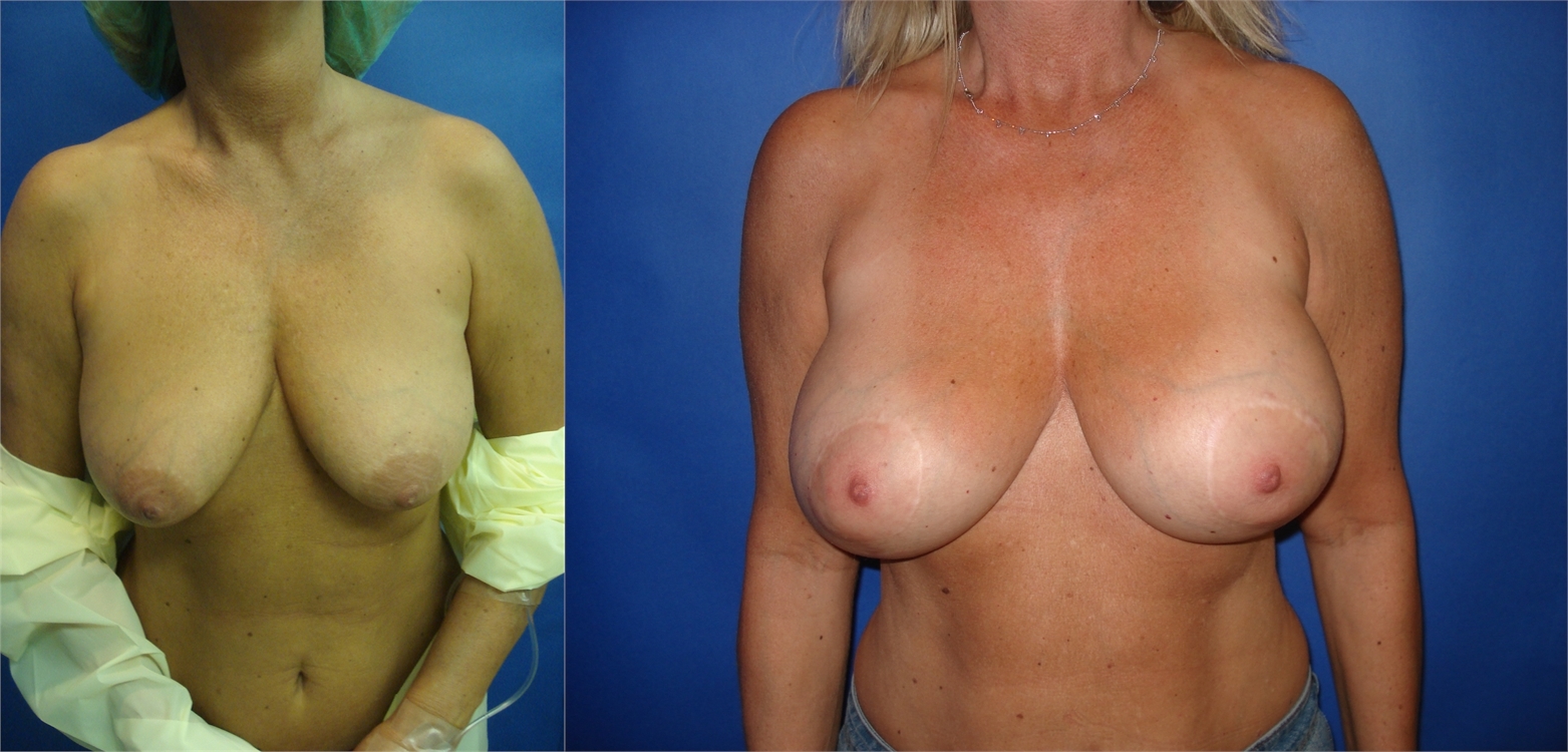 Before Breast Augmentation Surgery Tacoma, WA