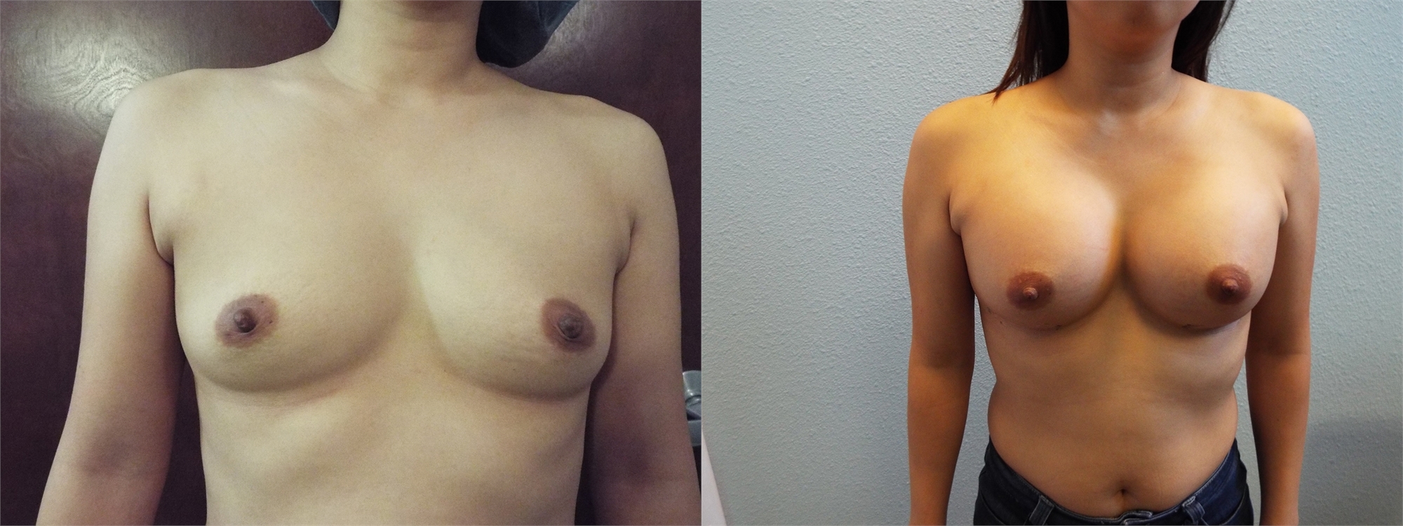 Before and After Breast Augmentation Tacoma, WA