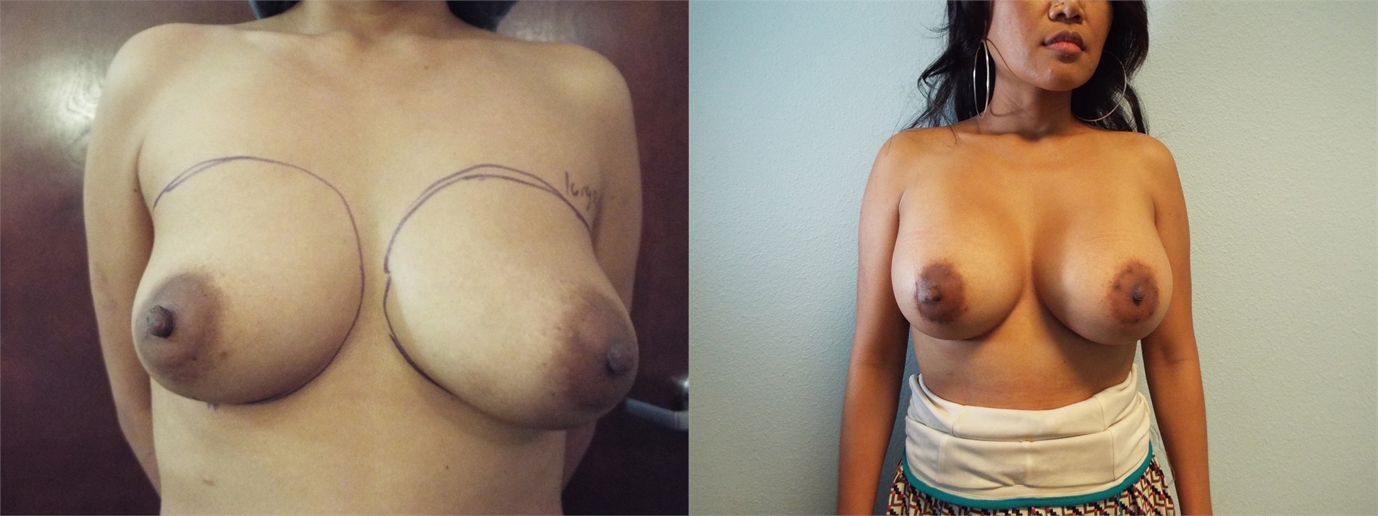 Before Breast Augmentation Surgery Seattle and Tacoma, WA