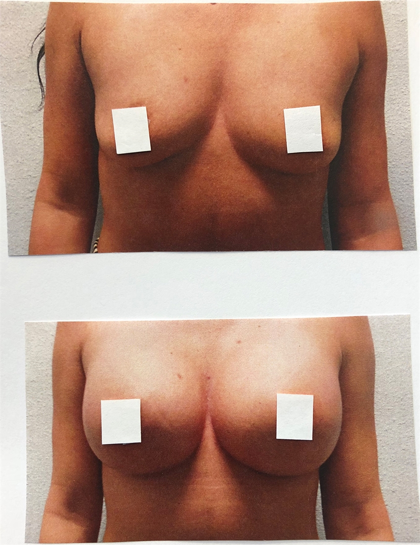 Breast Augmentation, Dr. Potyondy, Tacoma, WA 