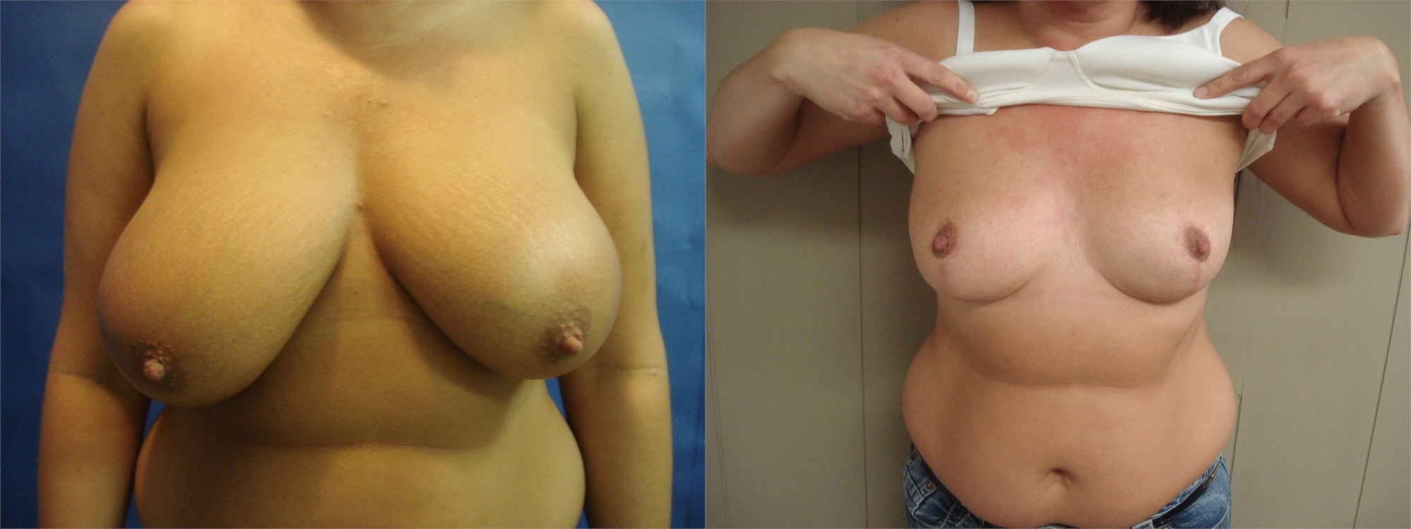 Breast Lift Before Surgery Tacoma, WA