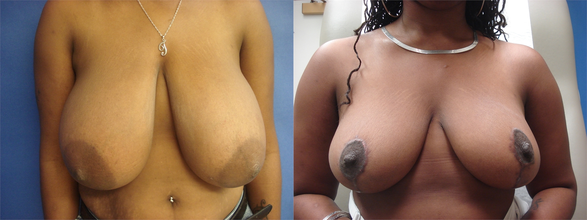 Breast Lift Before Surgery Seattle and Tacoma, WA