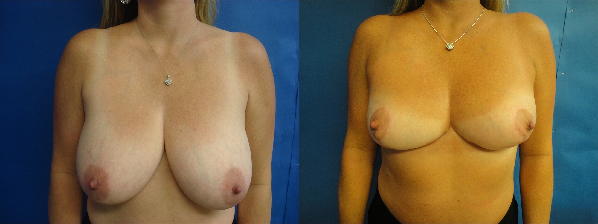 Before Breast Lift Surgery Seattle and Tacoma, WA