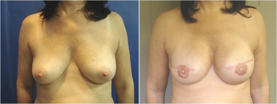 Before Breast Reconstruction Surgery Tacoma, WA