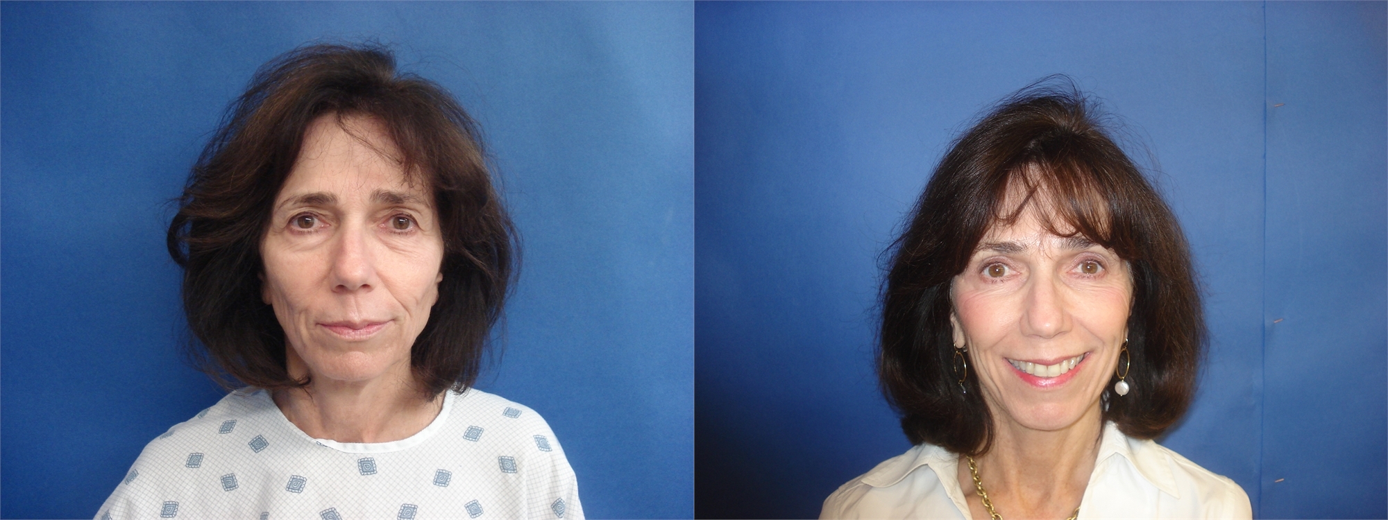 Facelift Before and After Surgery Tacoma, WA