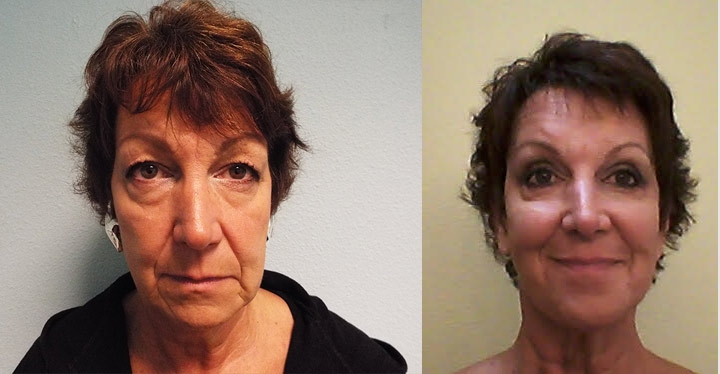 Mini Facelifts Before and After
