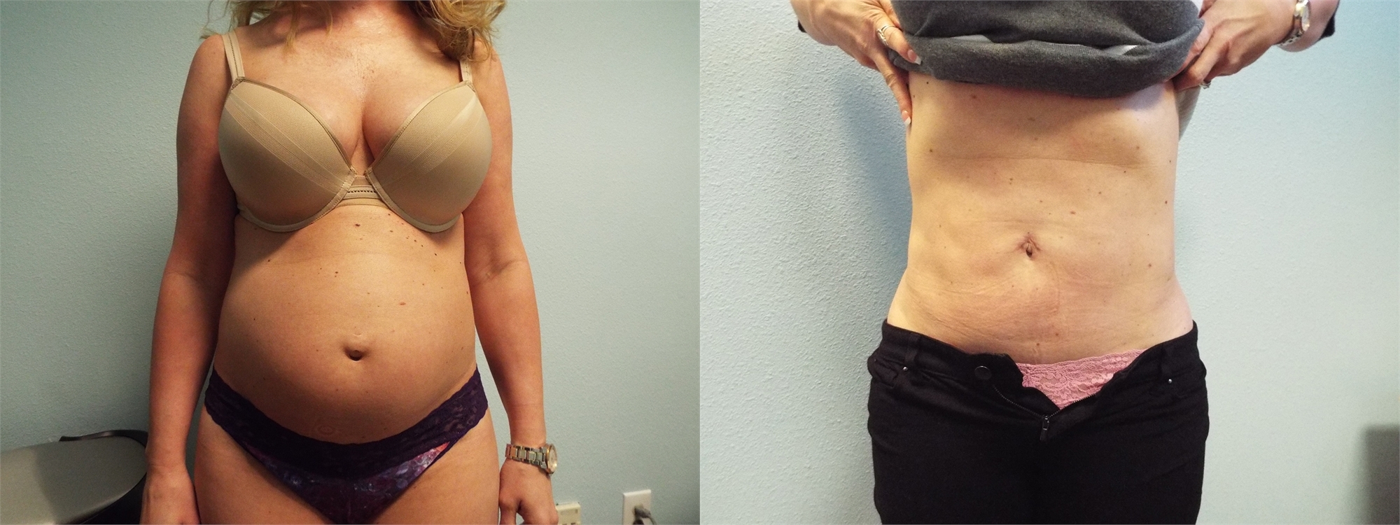Laser Liposuction Before and After Tacoma, WA