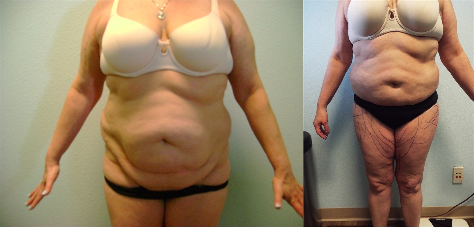 Liposuction Before and After Surgery Tacoma, WA