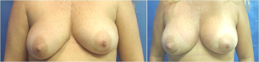 Saline Breast Augmentation Before Surgery Tacoma, WA