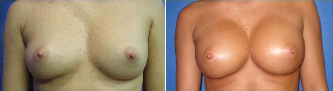 Before Saline Breast Augmentation Surgery Tacoma, WA